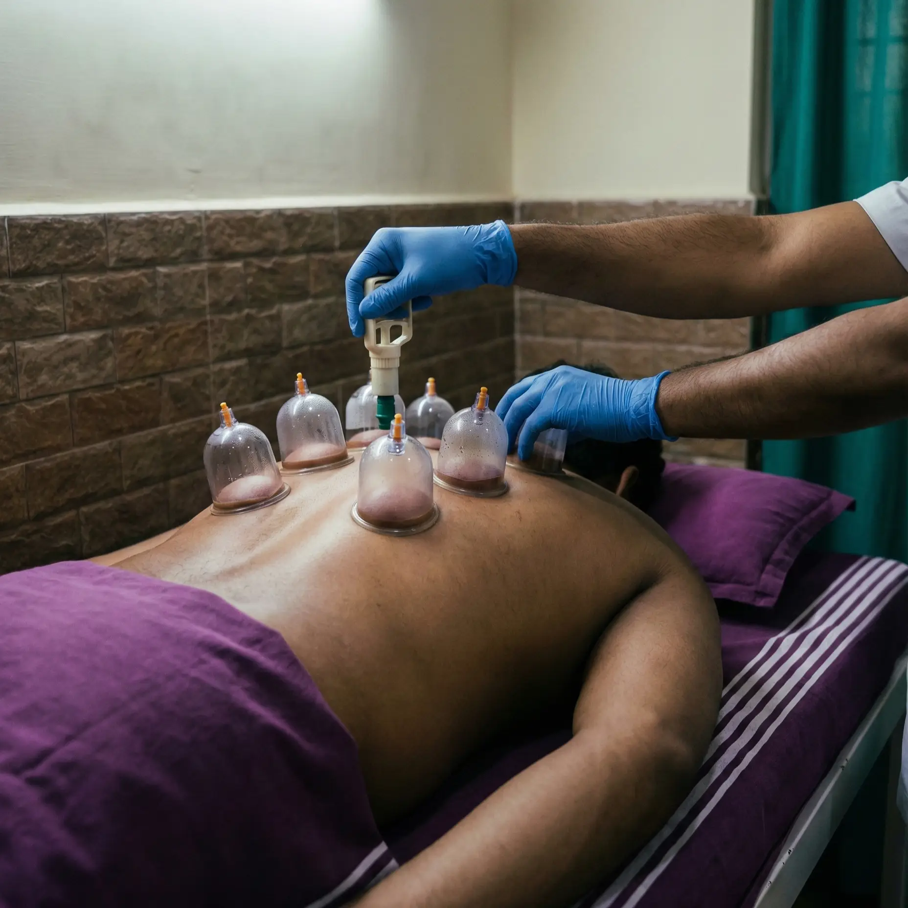 Hijama cupping therapy session for detox and pain relief treatment