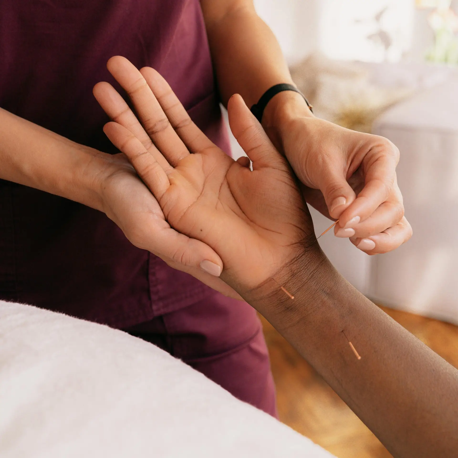 Acupuncture therapy session with fine needles on wrist for pain relief